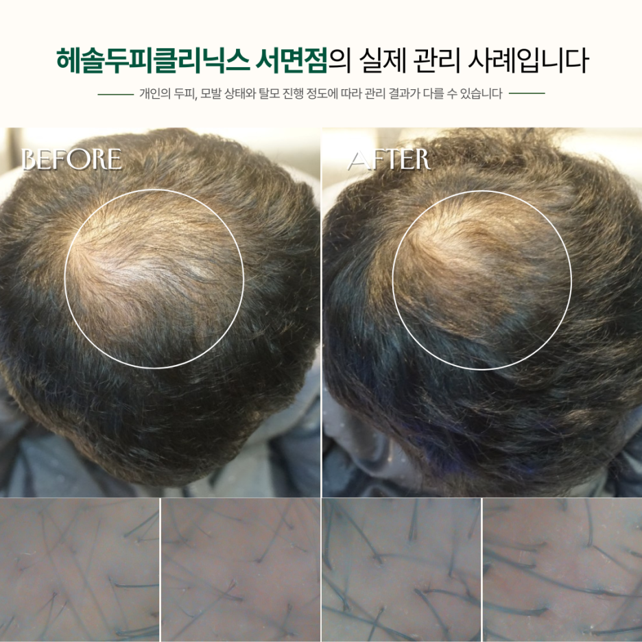 남성탈모 관리 사례 원본 이미지 3