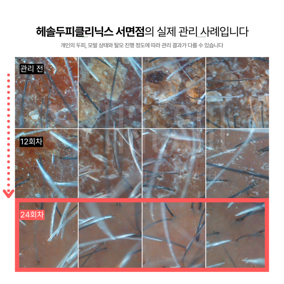 문제성두피 관리 사례 원본 이미지 1
