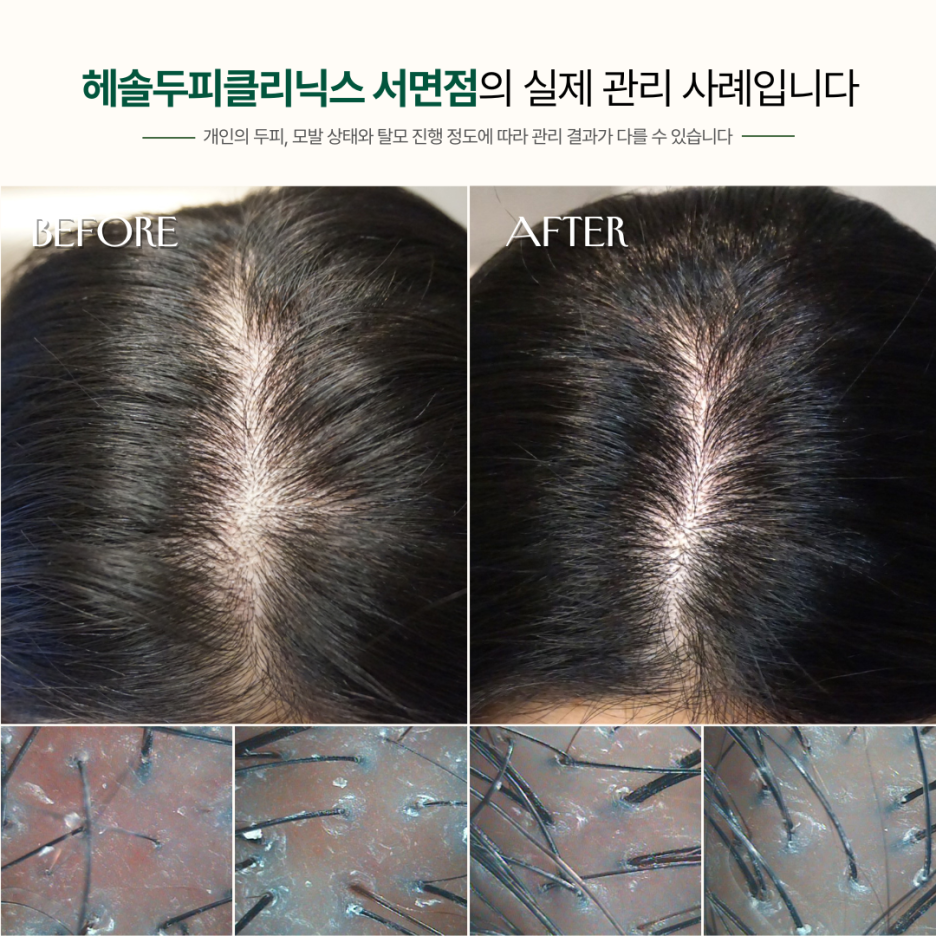 여성탈모 관리 사례 원본 이미지 1
