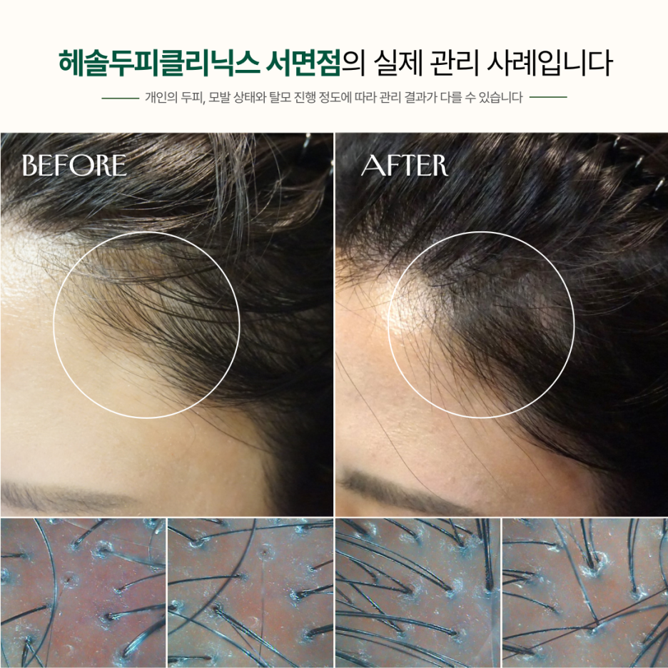 여성탈모 관리 사례 원본 이미지 5