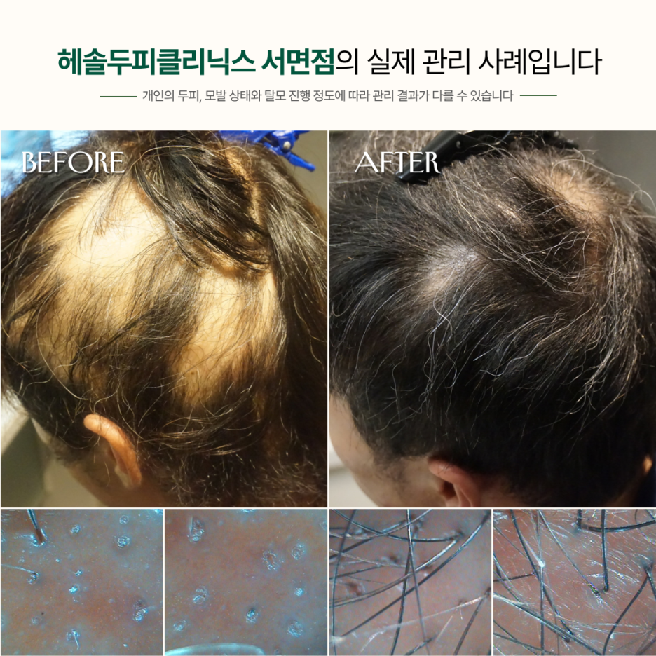 원형탈모 관리 사례 원본 이미지 2