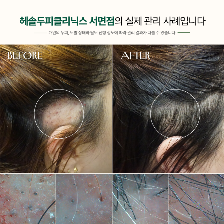 원형탈모 관리 사례 원본 이미지 4