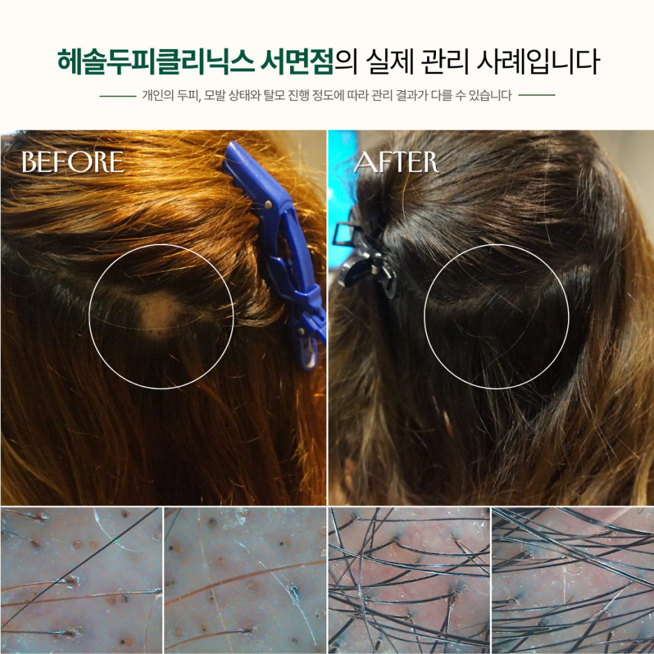 원형탈모 관리 사례 원본 이미지 5